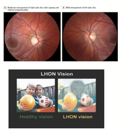 <ul><li><p>Degeneration of RGC's </p><ul><li><p>Enlarged optic disc</p></li><li><p>Temporal pallor</p></li></ul></li><li><p>Loss of central vision </p></li></ul><p></p>