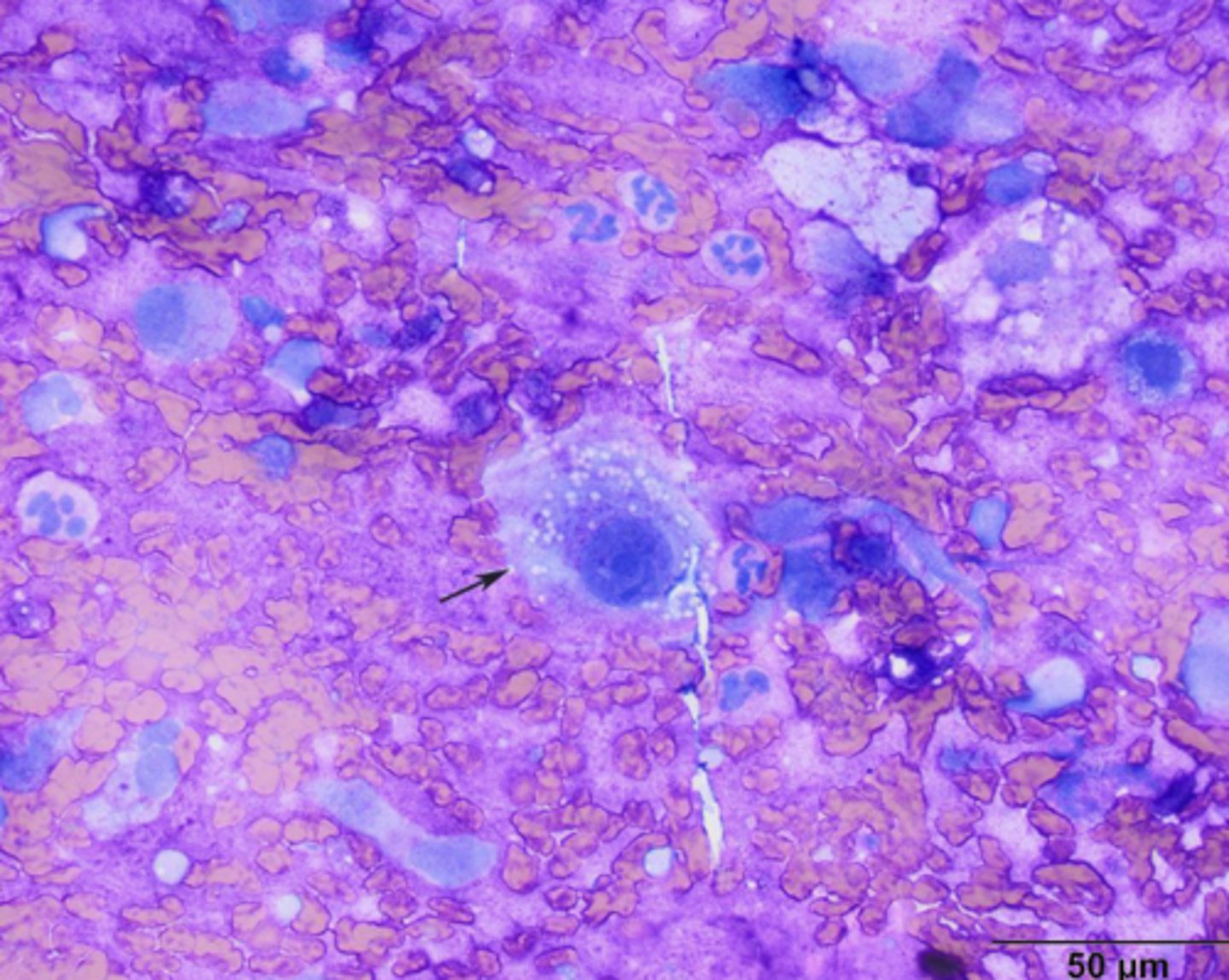<p>On this cytology sample, you note a bright, pink pool of granular material and round-spindle-shaped, large nuclei, blue cytoplasm with small, clear vacuoles.</p><p>What is your top differential?</p>