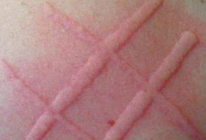 <p>what lesion is depicted</p>