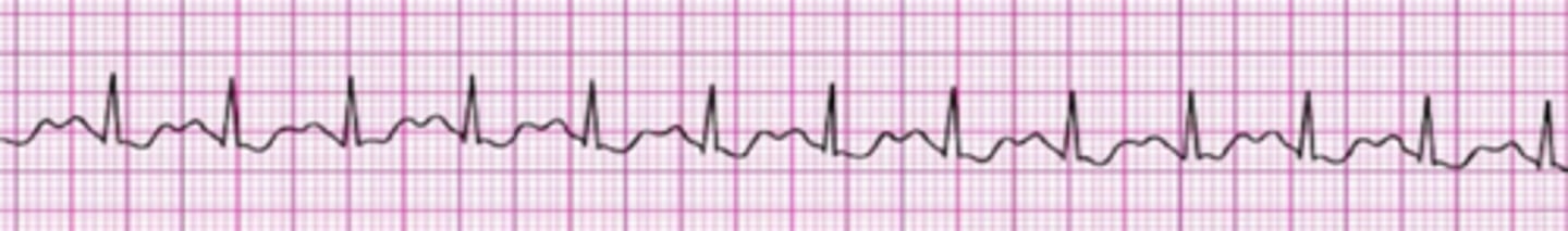 <p>Sinus Tachycardia</p>