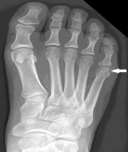 <p>Where do the erosions in RA usually occur?</p>