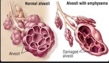 <p>normal - large surface area fro maximum diffusion and they expand and recoil to get all the extra air out</p><p>emphysema - smaller surface area and dosent recoil as much which can cause <span><span>persistent cough with mucus, wheezing, chest tightness, and fatigue.</span></span></p>