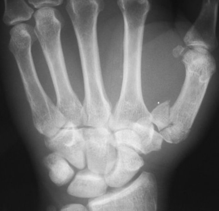 <p>fx that involves base of thumb metacarpal characterized by Y or T shaped intra-articular fracture line</p>