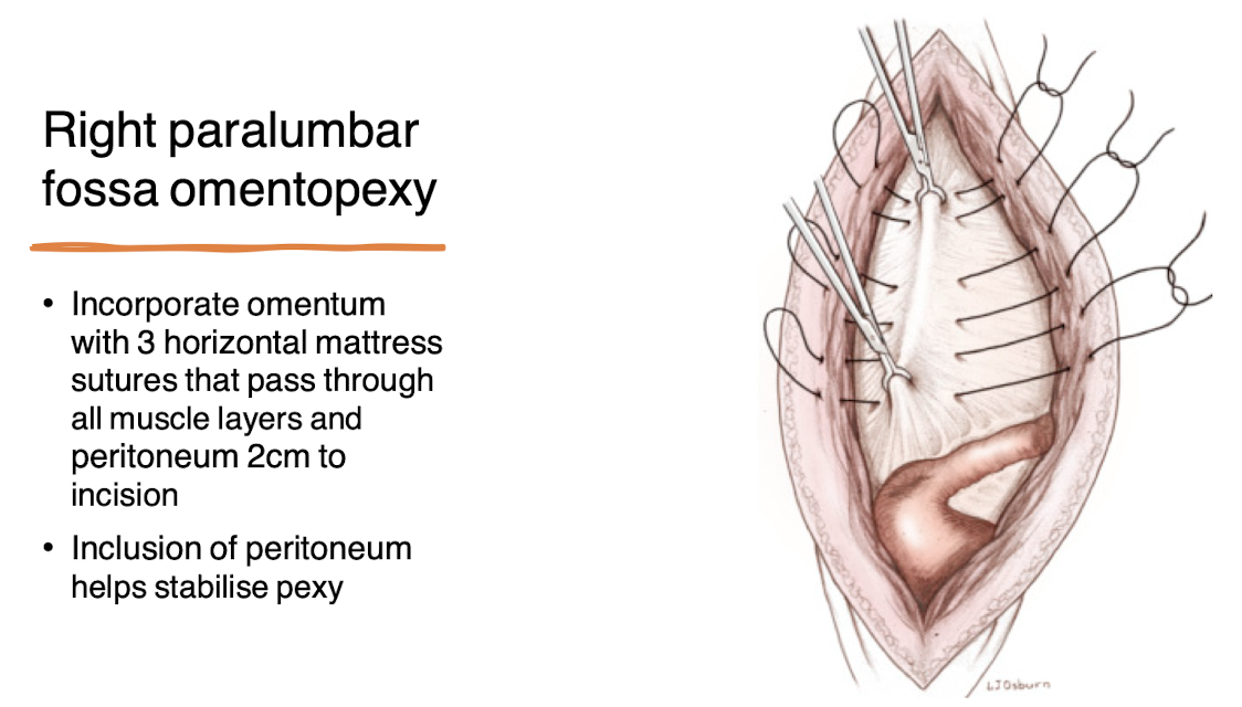 <p>A surgical procedure used to correct left displaced abomasum by attaching the omentum to the abdominal wall in the right paralumbar fossa, stabilizing the abomasum in its proper position. </p>