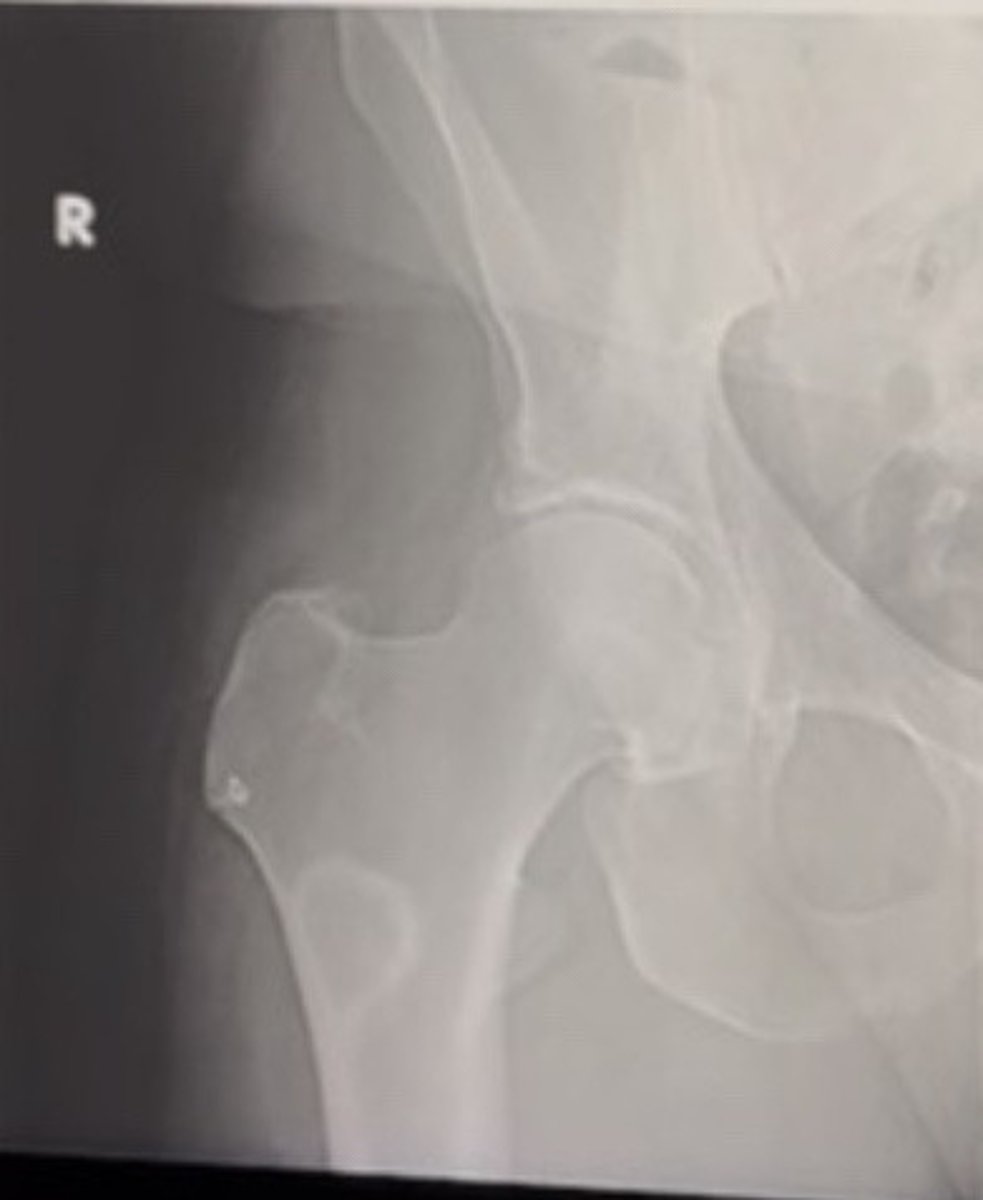 <p>37 year old male with hip pain</p><p>Based on the above findings, please pick one possible physical exam finding and an associated radiog aphic name sign that may not necessarly be seen here but could be seen in a patient with this condition</p><p>Pick two of these</p><p>- Cafe au lait » coant of Maine</p><p>• Fibroma moluscum</p><p>• hortased hat size</p><p>• Petic brim sign</p><p>• ribbon rib appearance</p><p>•rind of sclerosis</p>