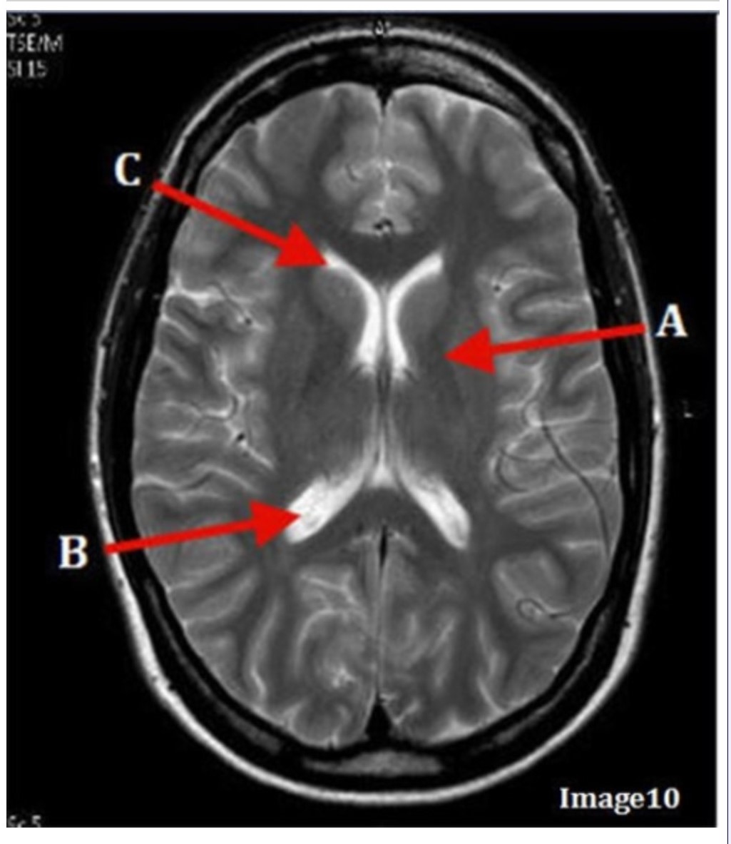 <p><span><strong>&nbsp;Letter B in Image 10 is pointing to:</strong></span></p><p><span>&nbsp;A. Third ventricle</span></p><p><span>&nbsp;B. Basal ganglia</span></p><p><span>&nbsp;C. Anterior horn lateral ventricle</span></p><p><span>&nbsp;D. Posterior horn lateral ventricle</span></p>