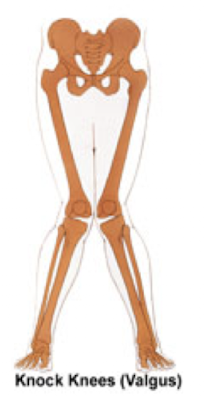 <p><strong>Valgus</strong> = <strong>outward angulation of the distal segment</strong> of a bone or joint.<br>Example: <strong>Knock-knees</strong> (knees move medially, ankles stay apart).</p><p>Load direction: <strong>lateral → medial</strong>.</p><p>Memory hook: <strong>ValGUS = knees go “in”</strong></p>
