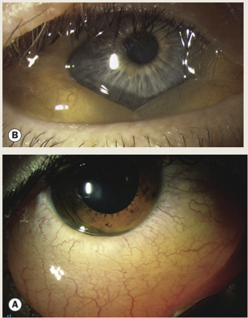 <ul><li><p>Itching and watering</p></li><li><p>Papillary reaction</p></li><li><p>conj hyperemia</p></li><li><p>conj chemosis&nbsp;</p></li></ul><p></p>