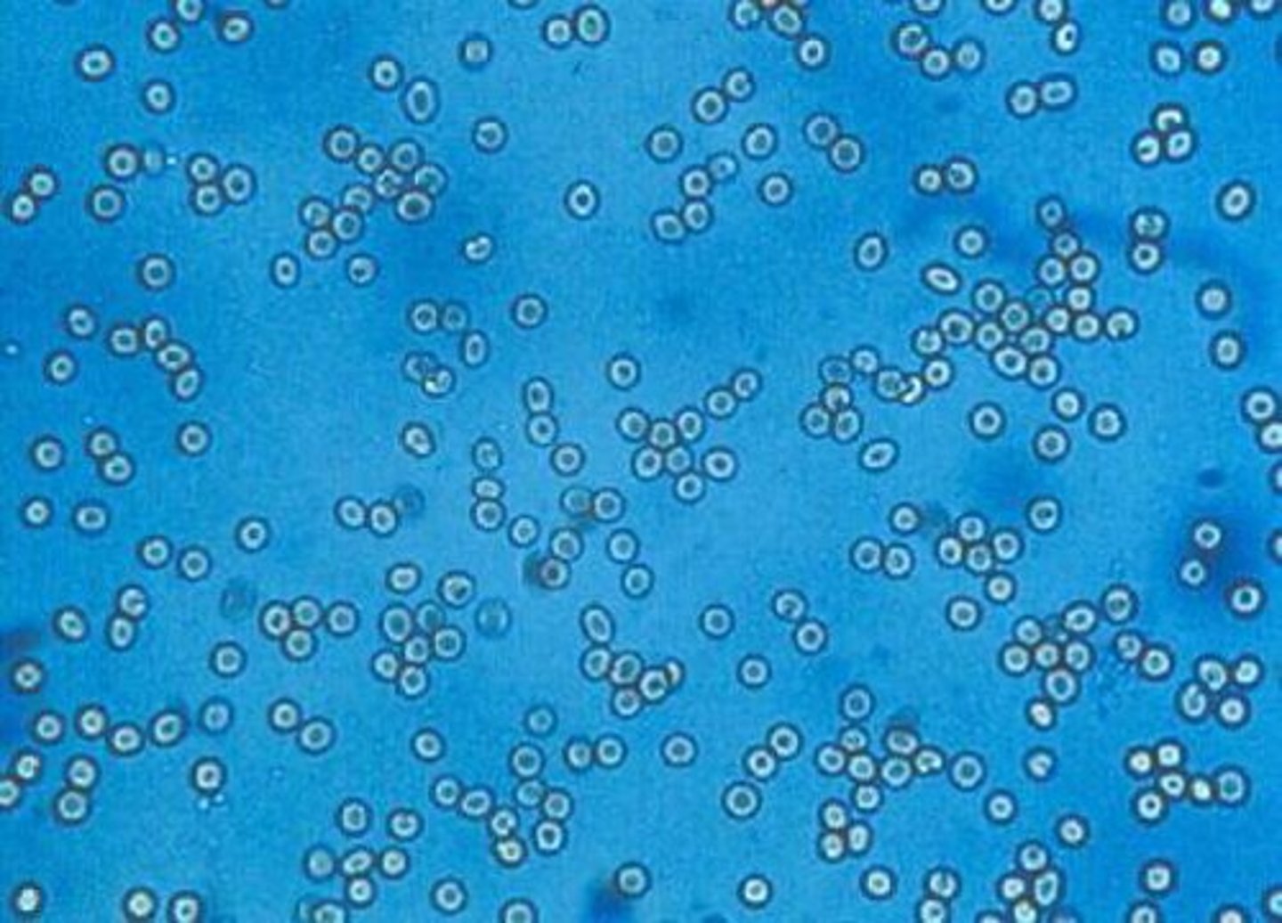<p>Biconcave disk, about 7 μm. Smooth. Non-nucleated.</p><p>significance: Infection, trauma, tumors, renal calculi. Dysmorphic RBCs indicate glomerular</p><p>bleeding.</p>