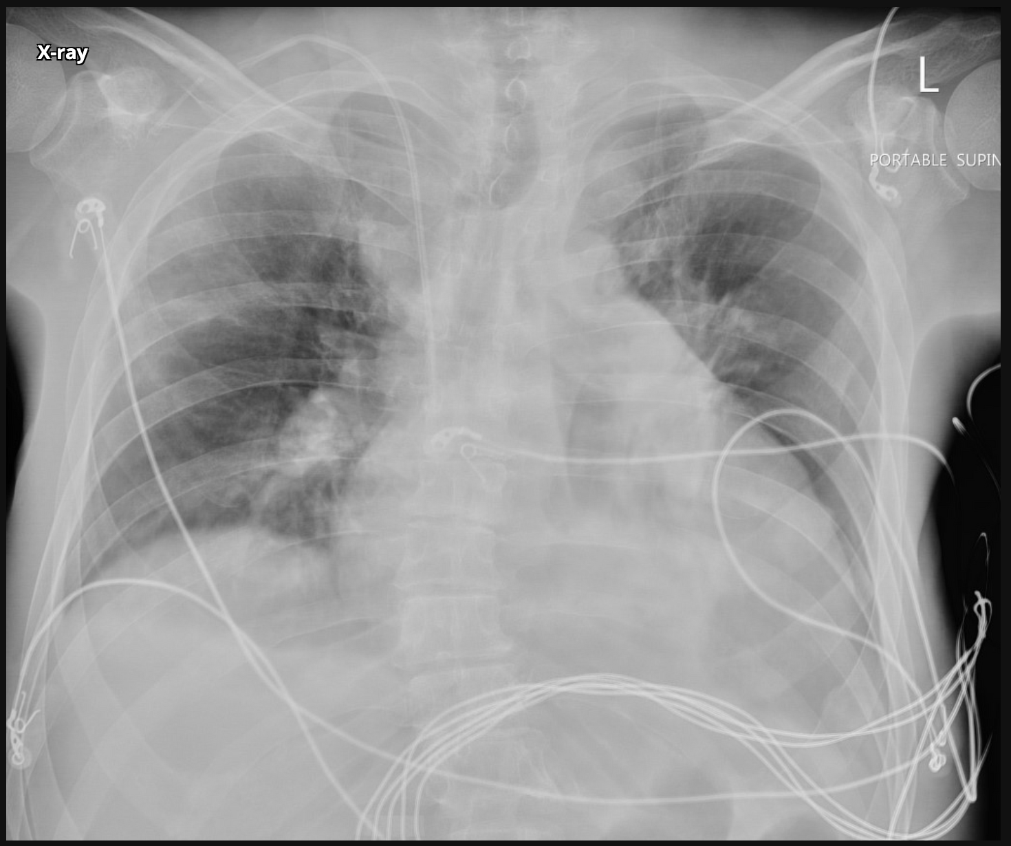 <p>Okay for our SOB/chest pain homie the EKG shows RVH and the chest xray looks like this. It’s giving Cor Pulmonae what is our treatment plan?</p>