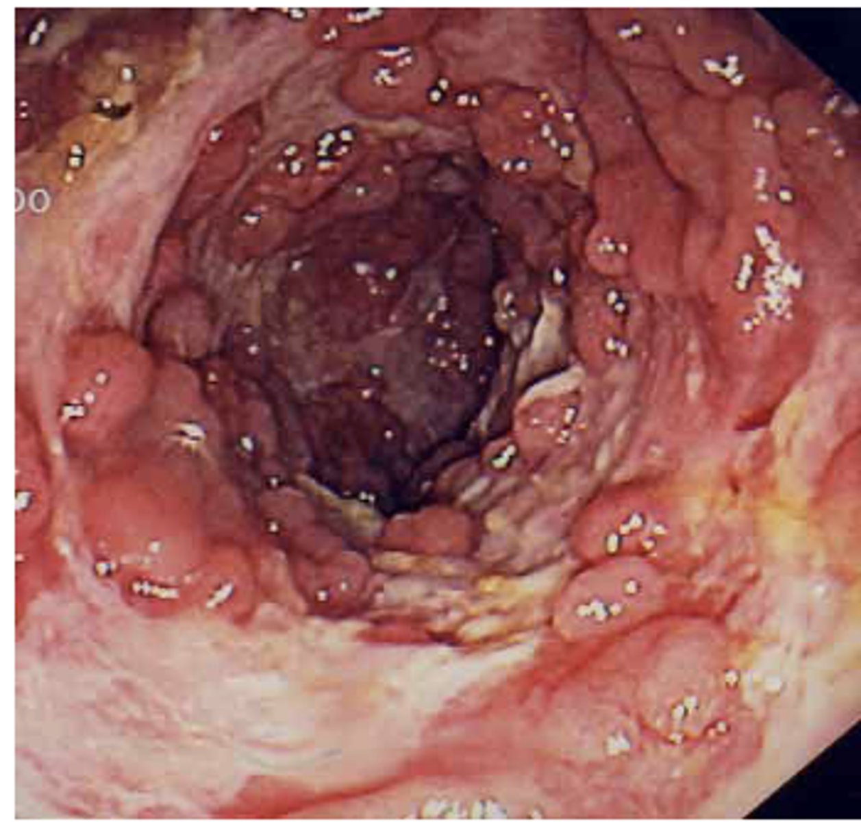 <p>ID this pathology:</p><p>- Signs and symptoms: chronic abdominal pain, diarrhea, weight loss, extra-intestinal manifestations</p><p>- Onset: 15-25, can be later</p><p>- Pathology: Transmural inflammation of bowel wall, can affect anywhere in GI, commonly spares rectum</p><p>- Complication: Intestinal obstruction, fistulas</p>