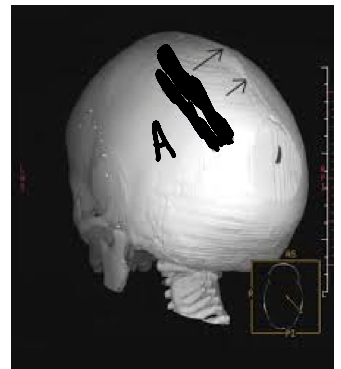 <p>A. synostosis of sagittal suture</p>