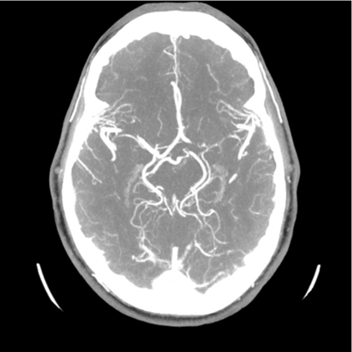 <p>stroke (ischemic), brain/spine tumors &amp; vascularity, AVM, fractures/spinal stenosis</p>