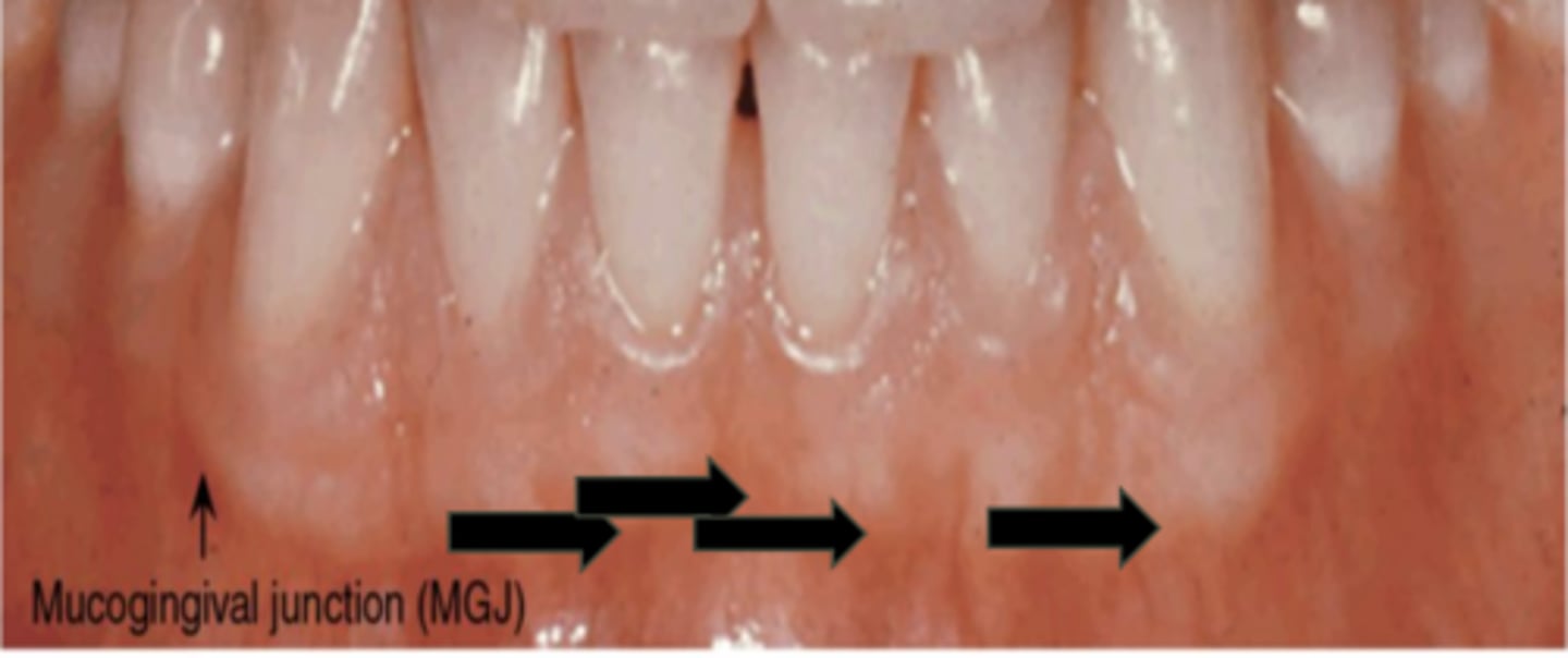 <p>The attached gingiva is continuous with the marginal gingiva (unattached). It is firm, resilient, and tightly bound to the underlying periosteum of the alveolar bone. It is demarcated from the relatively loose alveolar mucosa unattached gingiva by the MGJ</p>