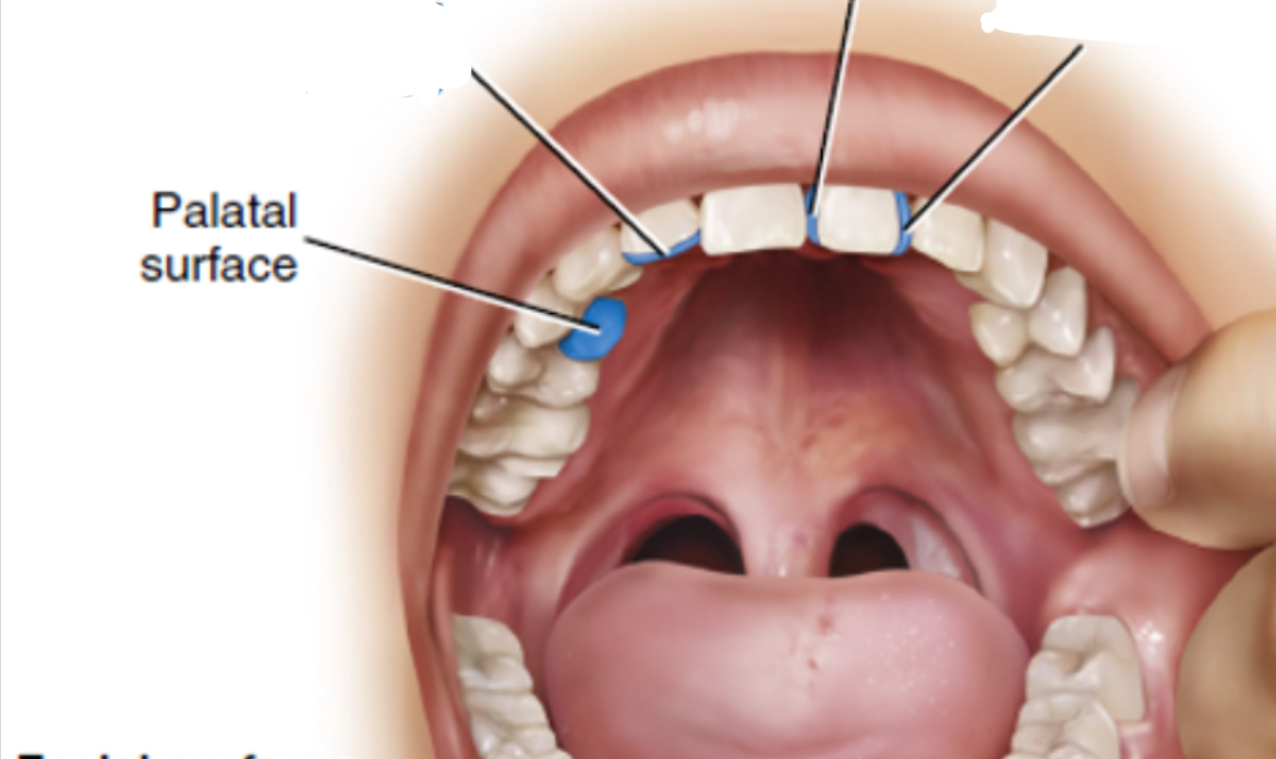 <p>Lingual surface of maxillary teeth </p>