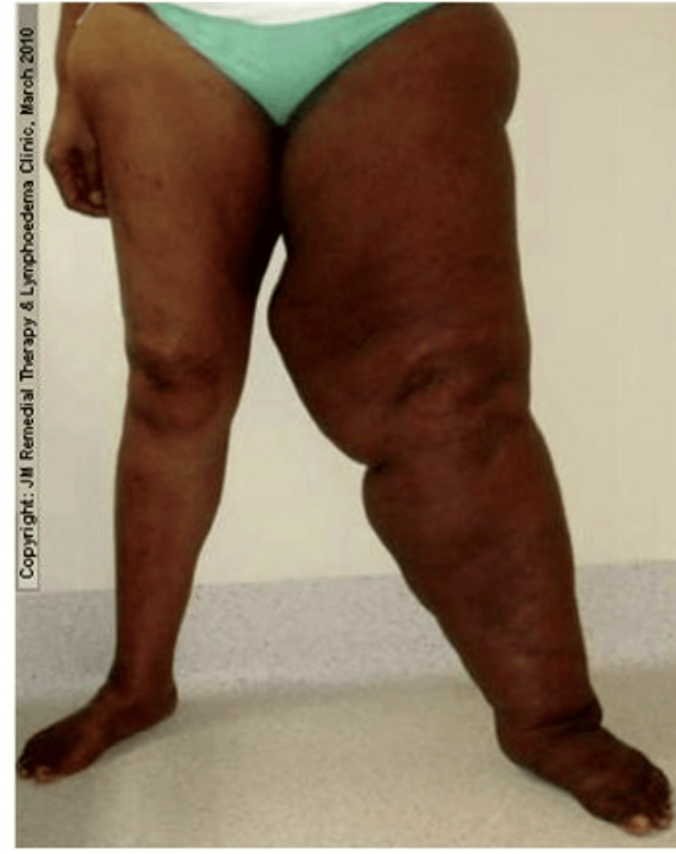 <p>edema due to impaired lymph flow is commonly referred to as lymphedema</p><p>may be caused by infection, surgical excision, or tumors</p>