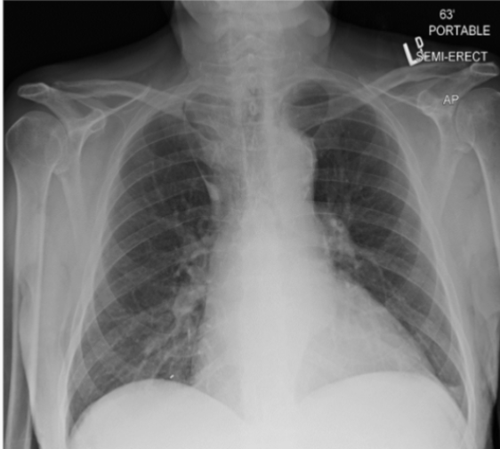 <p>What feature is notable about this patient’s X-ray?</p>