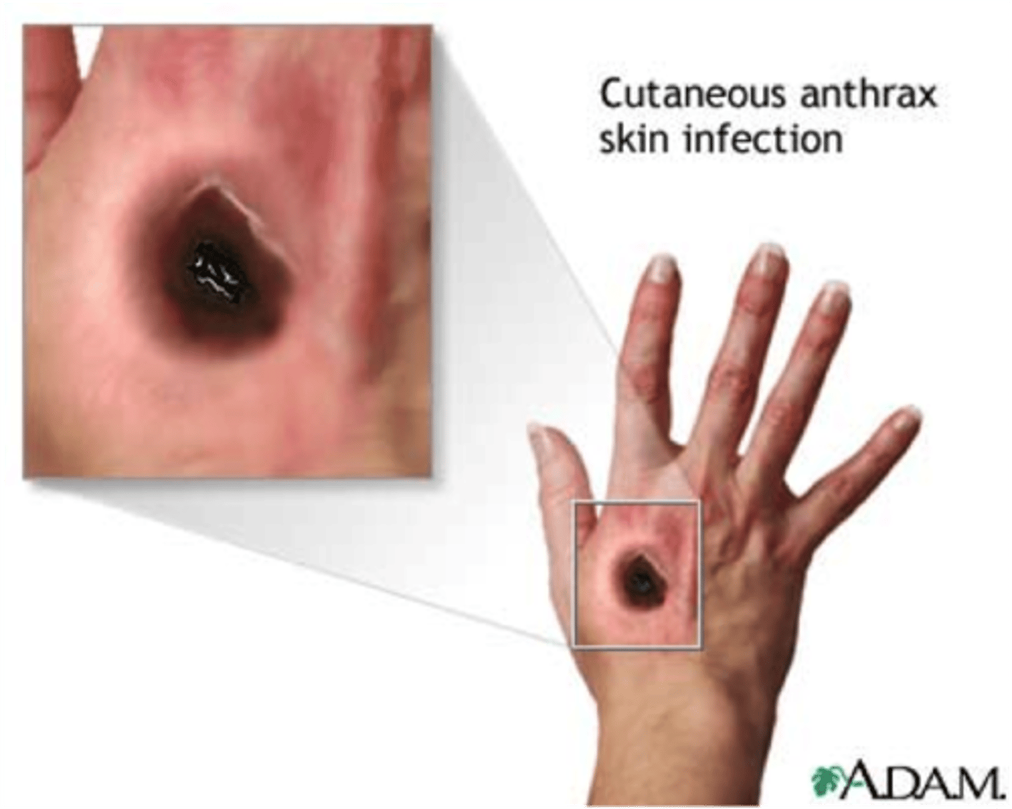 <p>CA: Bacillus anthracis<br>MOT: - endospore -&gt; open skin wound<br>Si/Sx: - wound - blister/black ulcer (eschar) -pruritis<br>Dx: -Hx -PE -methylene blue stain -lab culture -blood test<br>Tx: -PCN or eryhthromycin</p>