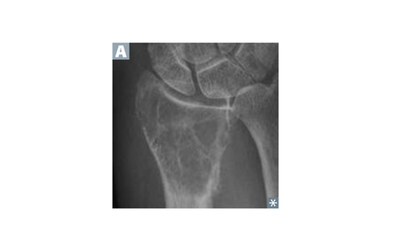 <p>tumor type: benign primary bone tumor</p><p>epidemiology/location:</p><p>- 20 to 40 yro</p><p>- at epiphyseal end of long bones, often around knee</p><p>- "Osteoclastoma"</p><p>characteristics:</p><p>- locally aggressive benign tumor</p><p>- "soap bubble" appearance on xray</p><p>- multinucleated giant cellls</p>