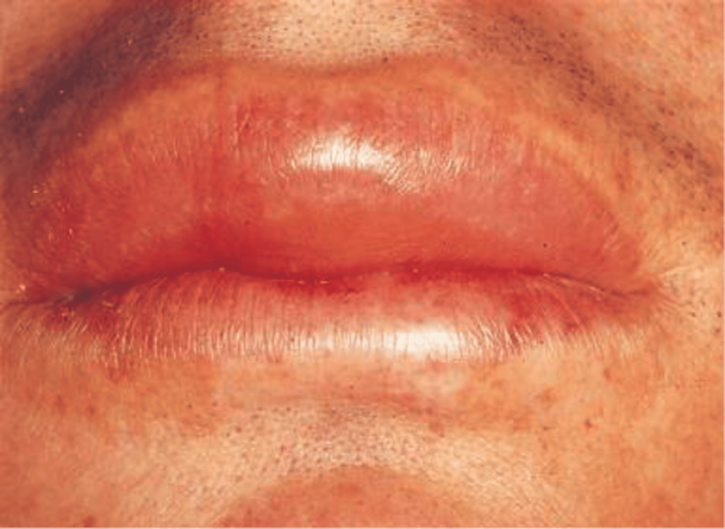 <p>Angioedema</p>