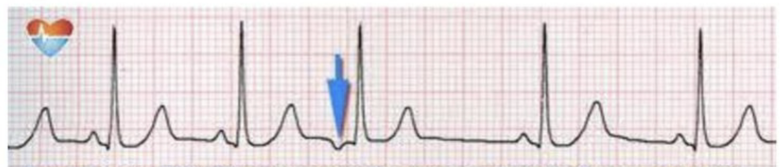 <p>What is the rhythm?</p>