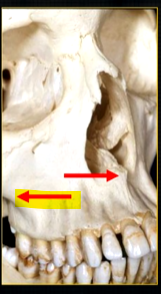 <p>posteriorly, the maxilla….</p>
