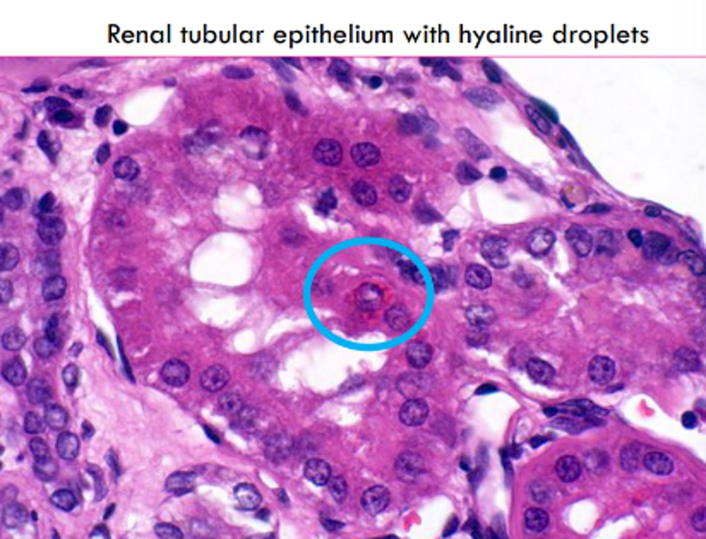<p>homogenous, eosinophilic, and translucent</p><p>can be intracellular or extracellular</p>