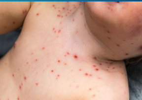 <p><strong>Varicella: Background and Symptoms</strong></p><p>-Etiology → ________ _______ virus </p><p>-Symptoms </p><ul><li><p>Prodromal period (_____, malaise, anorexia)</p></li><li><p>Rash (_______) → starts on the _____, followed by ____/face then extremities </p></li><li><p>Small red _________ → nonumbilicated, oval, “teardrop” _________ on erythematous base → ulcerates → _______ → heals </p></li><li><p>New crop of lesions for 3-4 days (lesions in __________ stages of healing) </p></li></ul><p></p>