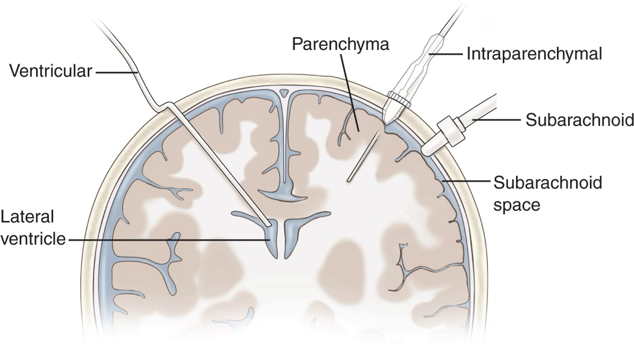 <p><span>Most common</span></p><p class="p1"><span>Increased risk for infection</span></p><p class="p1"><span>Can drain CSF</span></p><p class="p1"><span>*Can be done at the bedside</span></p>