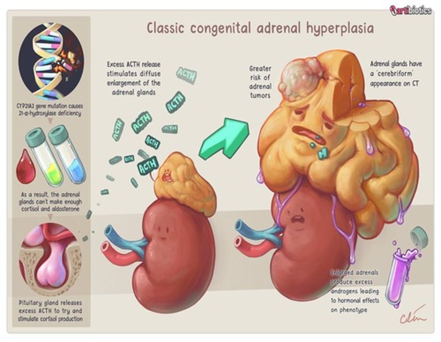 <p>Inborn error of steroid biosynthesis causing lack of cortisol and possibly aldosterone production.</p>