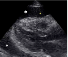 <p>What sign is pathological for Cardiac Tamponade?</p>