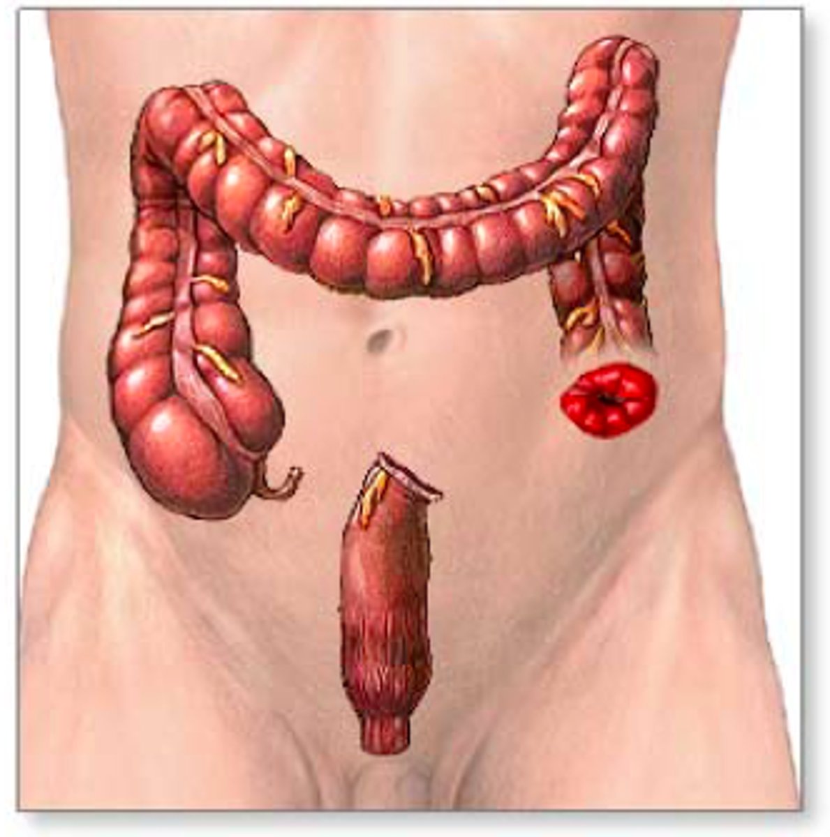 <p>usually on LHS</p><p>one stoma on abdomen wall</p><p>sometimes will have second stoma called mucous fistula</p><p>more complex reversing</p>