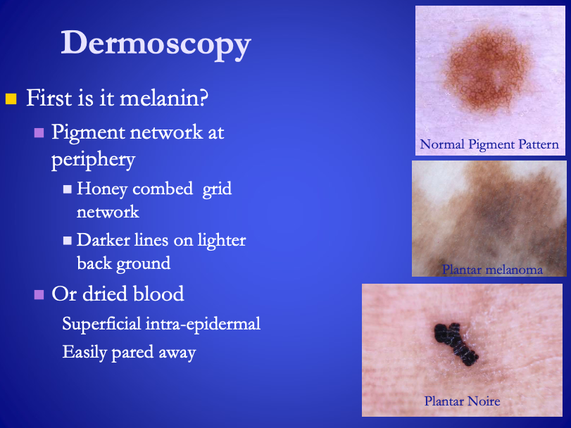 <p>Dermoscopy</p><ul><li><p><span><strong>[...]</strong></span> has a pigment network (honey combed grid network)</p></li><li><p><span>Dried blood</span> is easily cut away</p></li></ul><p></p>