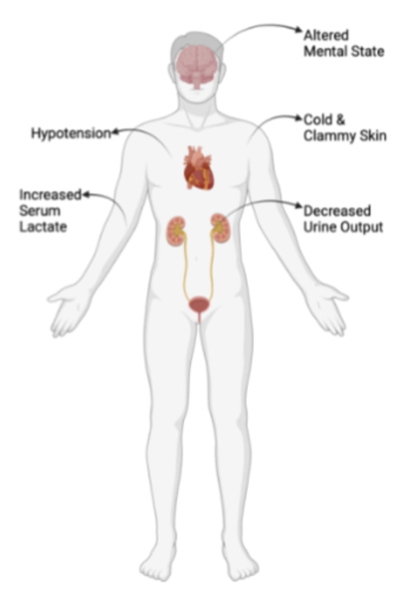 <p>- MAP: <70 mmHg</p><p>- Cold and Clammy</p><p>- Decreased Urination</p><p>- Elevated Lactate levels</p>