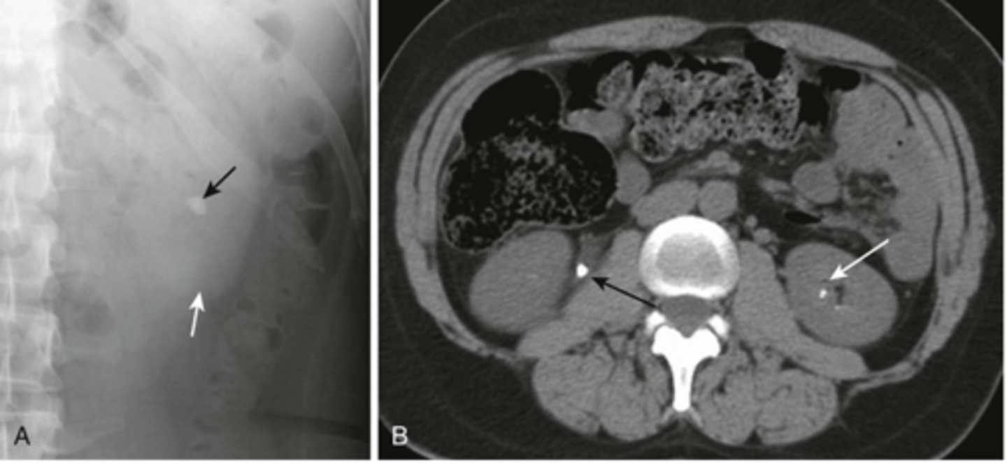 <p>stone in R ureter, stone in L kidney</p>
