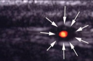 <p>What pathology is seen here? </p>