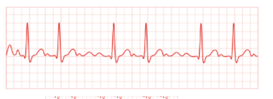 <ul><li><p>Atria beating more frequently than ventricles so no clear P wave is seen</p></li></ul><p></p>
