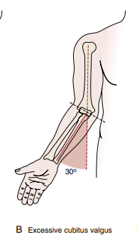 <p>Cubitus Valgus</p>