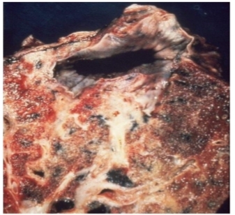 <p>Identify and What is a characteristic apical lesion ? What often occurs in most cases?</p>