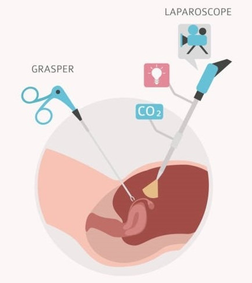 <p>a surgical procedure done in a manner that causes little or no trauma or injury to the patient, often performed through a cannula using lasers, endoscopes, or laparoscopes; it involves smaller incisions &amp; minimal scarring with less tissue damage, bleeding, anesthesia, &amp; pain</p>
