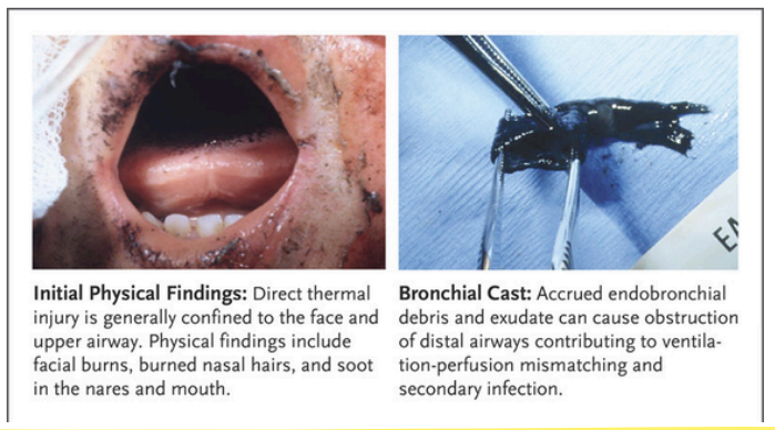 <ul><li><p>%TBSA (total body surface area)</p></li><li><p>Inhalation injury</p></li><li><p>Involvement of the head, lower extremity, and perineum</p></li></ul><p></p>
