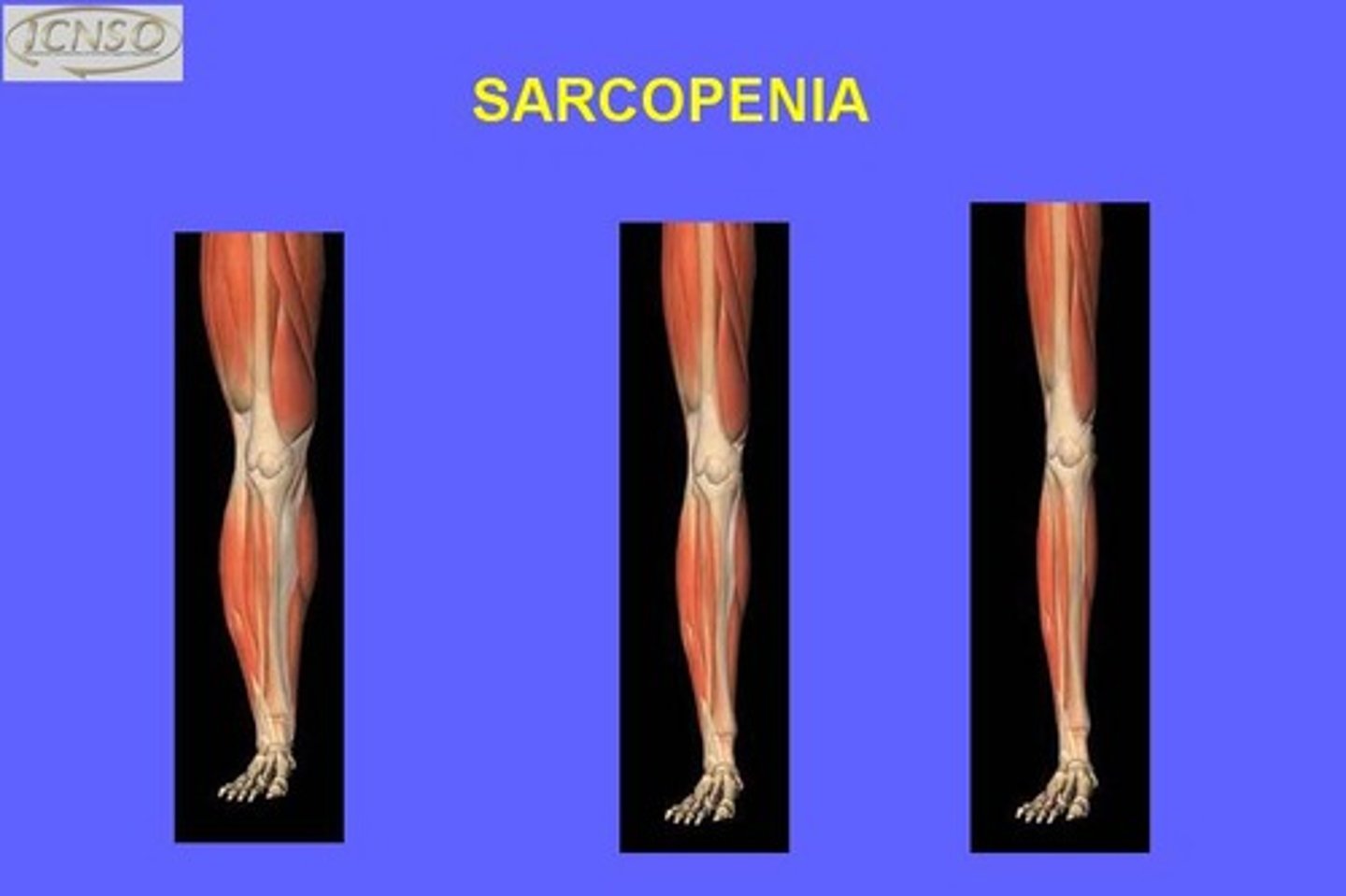 <p>is the loss of muscle mass, strength, and function that come with aging (sarc/o = flesh, and -penia = deficiency).</p>