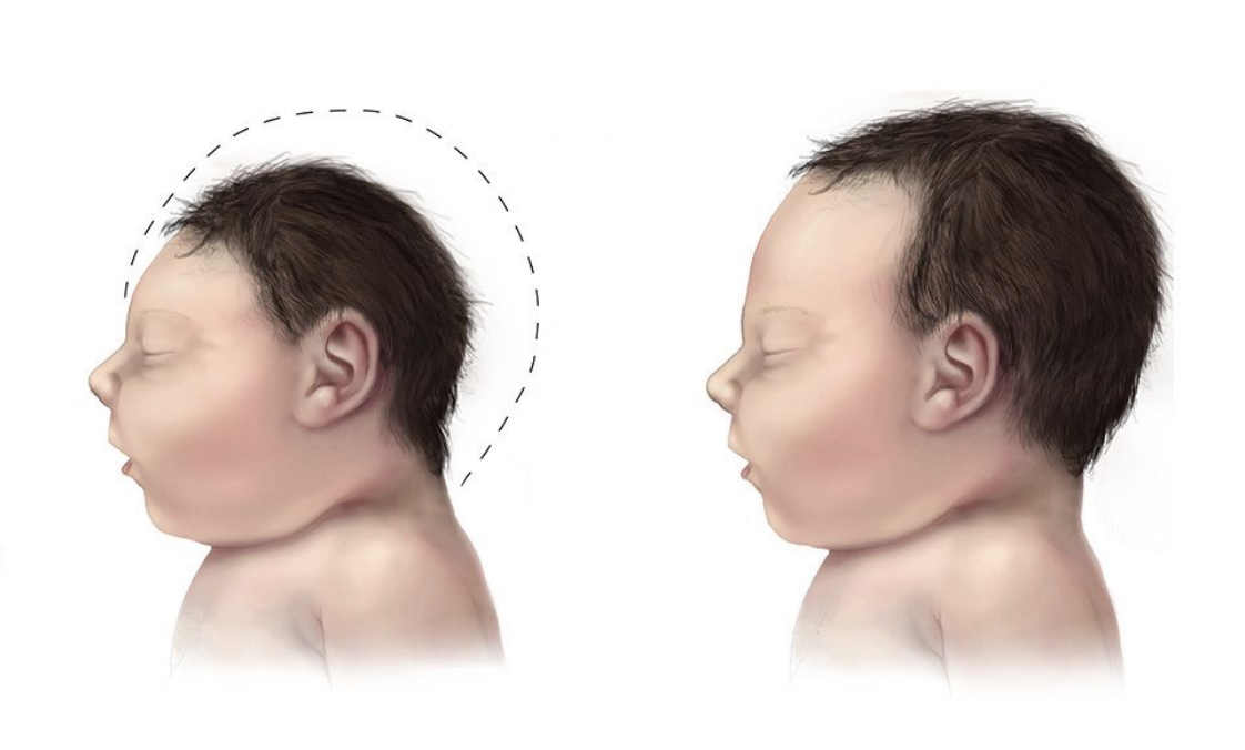 <p>Linked to <strong>microcephaly</strong> in newborns — babies born with smaller brains.</p><p></p>
