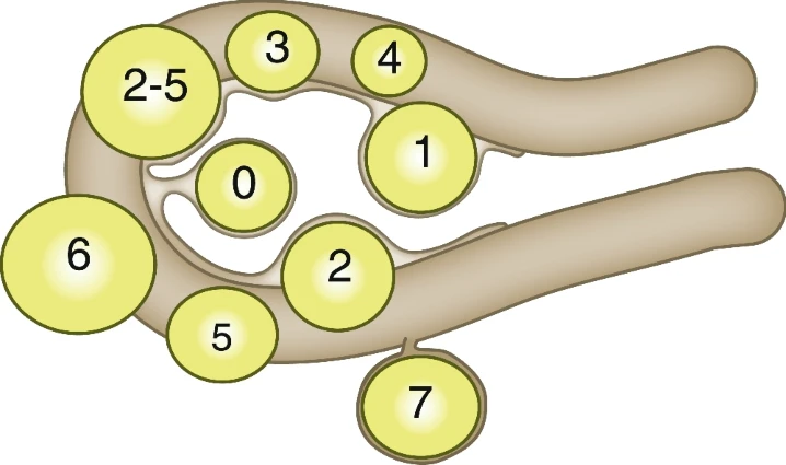 <ul>
<li><p>= benign muscle tumours</p></li>
<li><p>well defined</p></li>
<li><p>fibroids can be situated in an intrauterine, submucosal intramural (which means in the muscle of the uterus) or subserosal position</p>
<p>classified with PALM-COEIN with numbers 0-7 (FIGO classification for fibroids)</p></li>
<li><p>circumferential flow</p></li>
<li><p>type 0-2 to 5 (intracavitary or partly intracavitary fibroids) can cause AUB and HMB while 5-7 (located on the serosal side) often give bulk symptoms</p></li>
<li><p>there are 2 explanations as to why myomas may cause HMB</p>
<ol>
<li><p>fibroids → insufficient compression of the vessels → lack of effective contraction of the uterus muscle</p>
<p>==<strong><strong>WOULDNT THIS CAUSE LESS BLEEDING OUT? WONT IT STAY IN THE UTERUS IF ITS NOT CONTRACTING????????????</strong></strong>==</p></li>
<li><p>fibroids → increasing intrauterine surface → more endometrial tissue → HMB</p></li></ol></li>
<li><p>characteristic on MRI → </p></li>
</ul>
