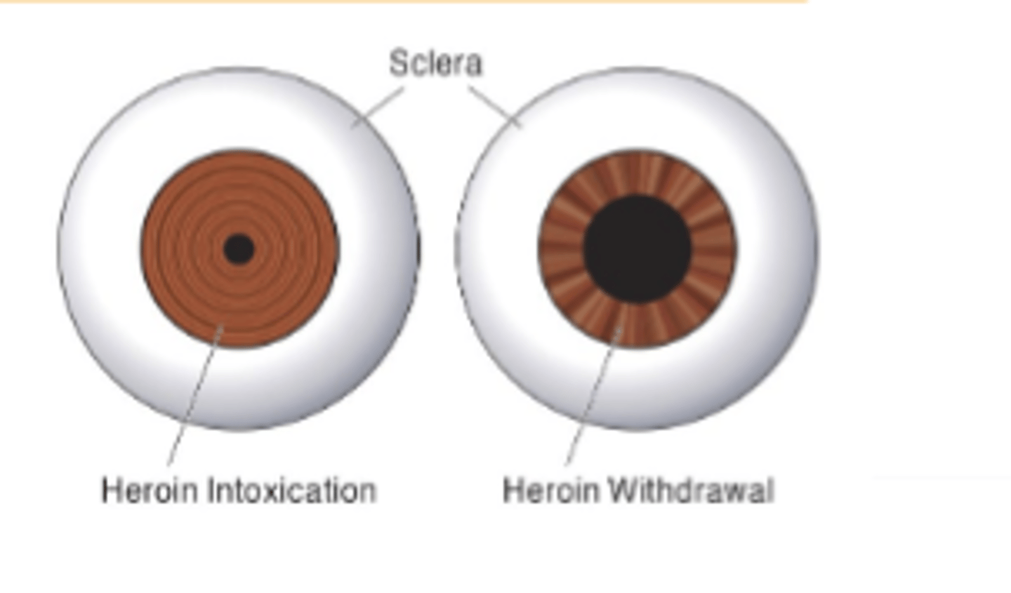 <p>Pupil constriction</p><p>Miosis mediated by activation of μ andκ receptors in Edinger-Westphal nucleus- Second sign of acute opioid intoxication is pinpoint pupils.</p>