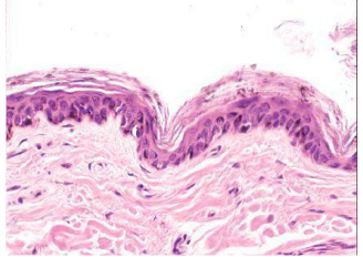 <p>Incrmento de la melanina en la epidermis/dermis superficial</p><ul><li><p>Difusa: endocrinopatías</p></li><li><p>Local: lentigo, en el centro de collarete secundario a inflamación o hipersensibilidad</p></li></ul><p></p>