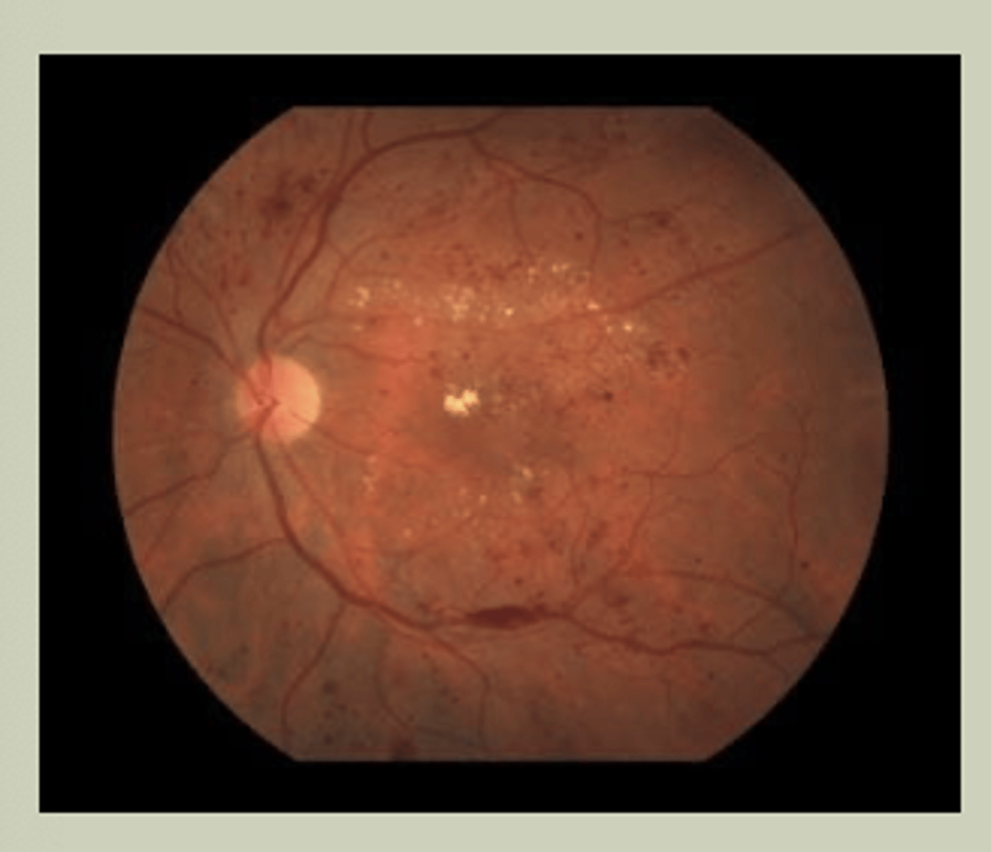 <p>-Gradual change to vision bilaterally</p><p>-Hx of DM for many years</p><p>-May see blood, exudates, areas of ischemia with DO</p><p>-TX: URGENT referral to ECP</p>