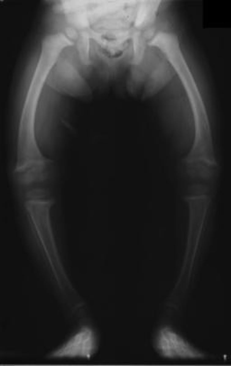 <p>x-ray of legs of toddler</p>