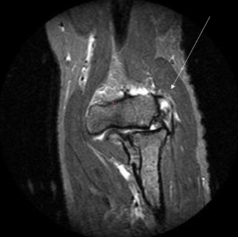 <p>Describe the pathology indicated by the arrow (Cor T2 FS). </p>