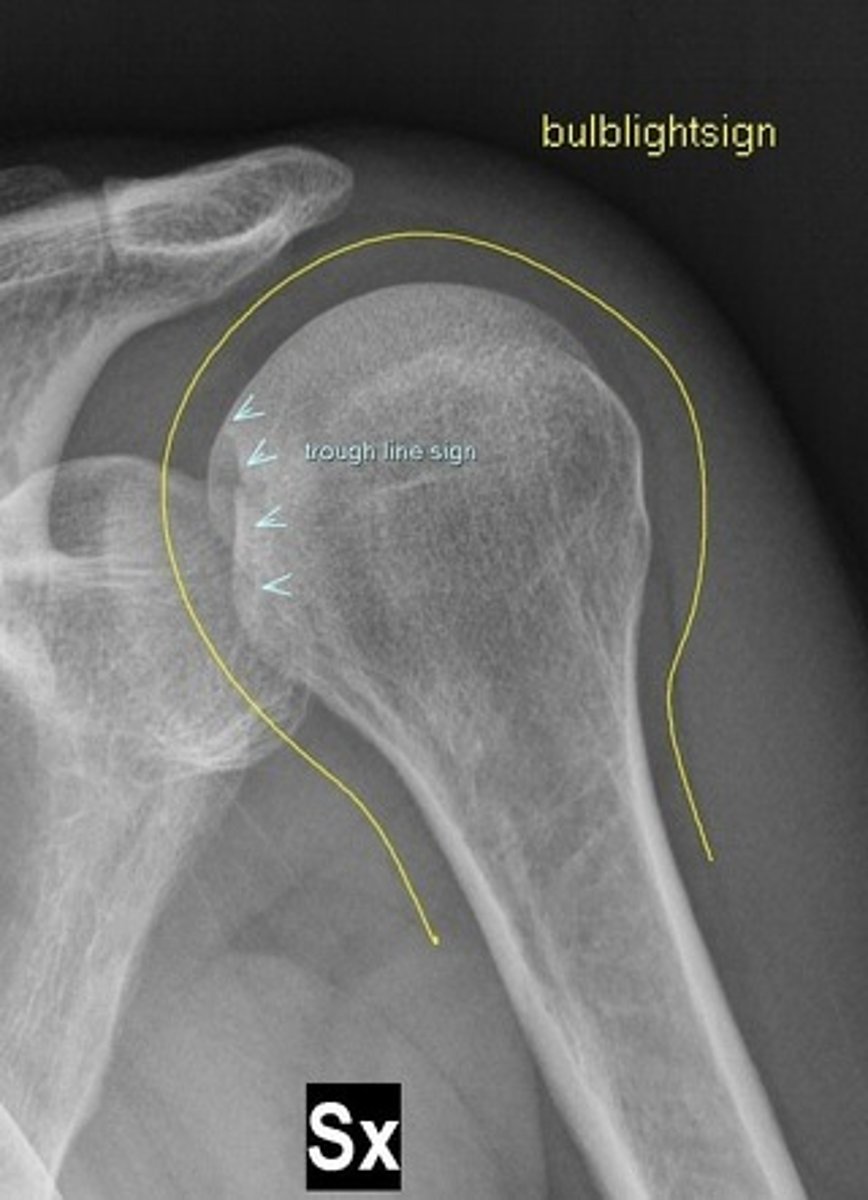 <p>loss of half-moon shape/vacant glenoid/lightbulb tennis racquet sign</p>